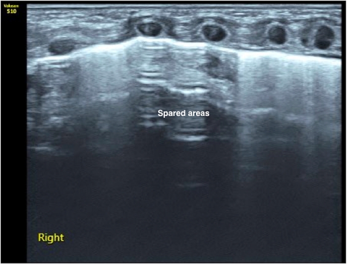 Ultrasound imaging showing spared areas, medical diagnostic process, cross-sectional view.