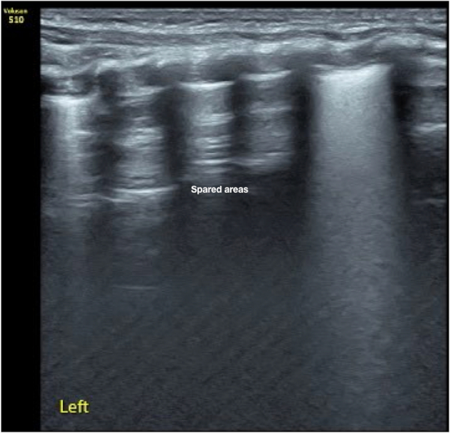 Ultrasound image diagnosing lung condition; spared areas labeled; used in medical analysis.