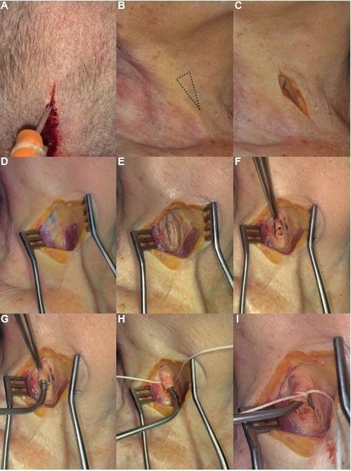 Surgical procedure steps; skin incision, muscle exposure, tissue dissection, suturing; medical diagram.