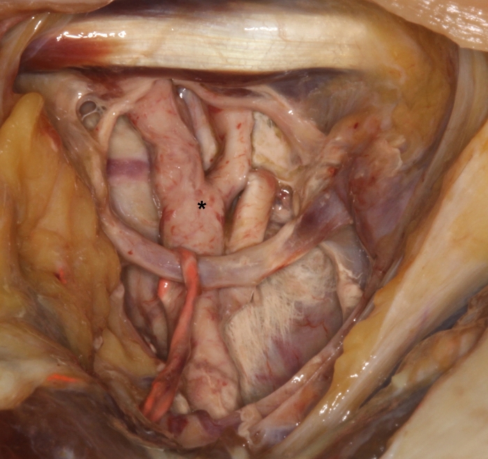 Anatomical dissection showing neck arteries and nerves diagram.