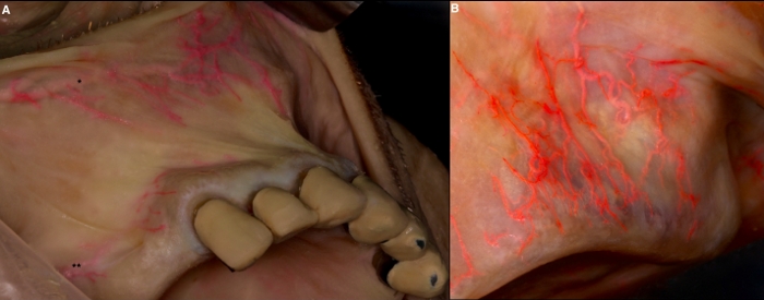 Anatomy diagram; vessels in oral cavity visualized with fluorescence for medical research.