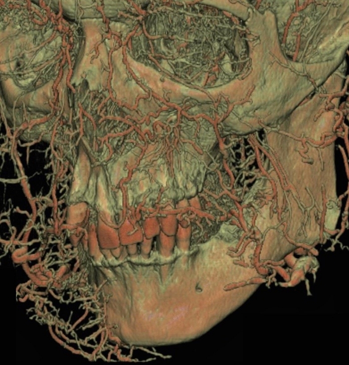 3D skull model with vascular network, anatomical diagram, used for educational study of human biology.