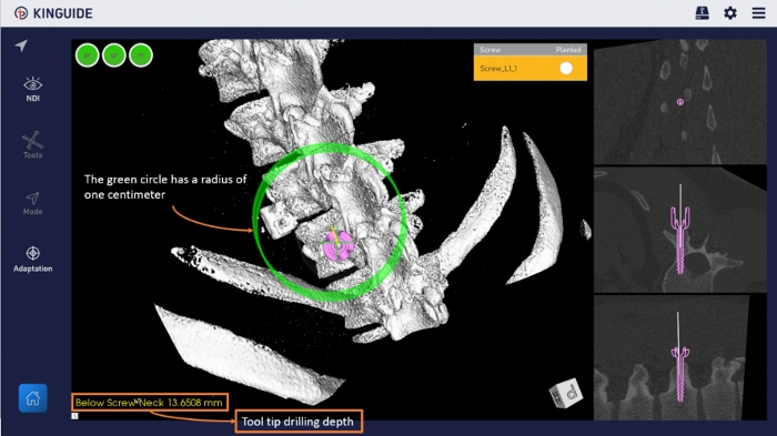 Spinal surgery planning, CT scan diagram with tool depth, screw placement analysis, anatomical overlay.