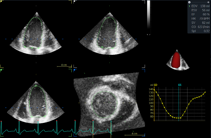 Evaluation of Left Ventricular Structure and Function using 3D ...