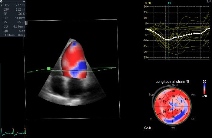 Evaluation of Left Ventricular Structure and Function using 3D ...
