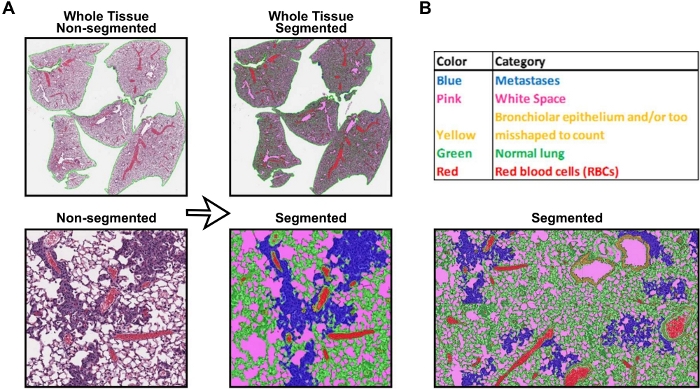 Tissue segmentation process, diagram with color-coded annotations for metastases, lung tissue analysis.