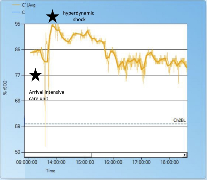 figure-results-3 Graph of % rSO2 levels over time showing patient status in ICU and hyperdynamic shock events.