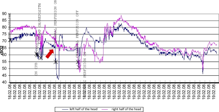 figure-results-5 Cerebral oxygen saturation graph; monitoring left and right brain perfusion changes over time.
