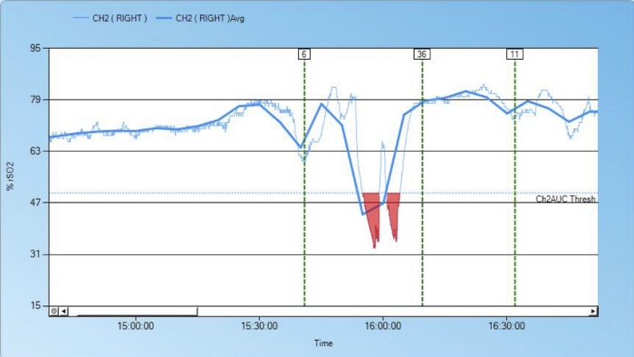 figure-results-6 Time series graph, %SO2 measurement; channel analysis; data fluctuation observation.