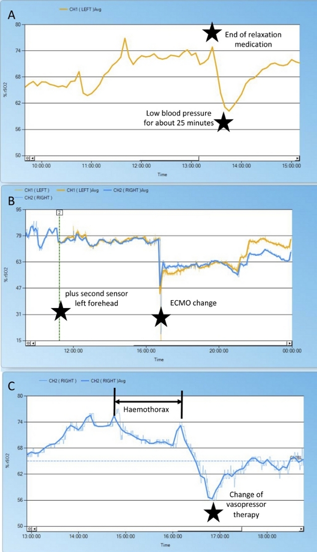 figure-results-7 Blood oxygen saturation monitoring charts showing medication effects and ECMO changes.