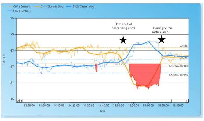 figure-results-2 Aortic clamp removal chart showing %rSO2 changes, data trends, and annotations over time.
