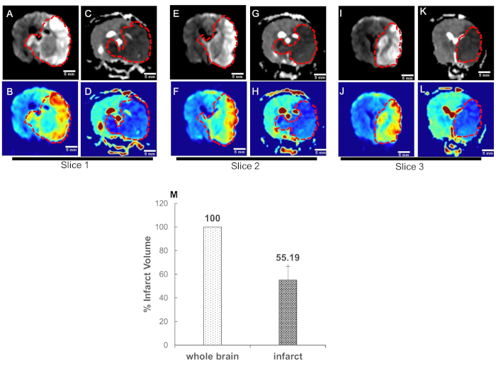 Quantification of Cerebral Perfusion using Laser Speckle Imaging and ...