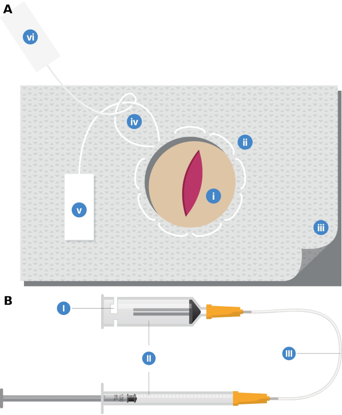 Surgical drape layout and syringe system diagram for medical procedure setup and infusion process.