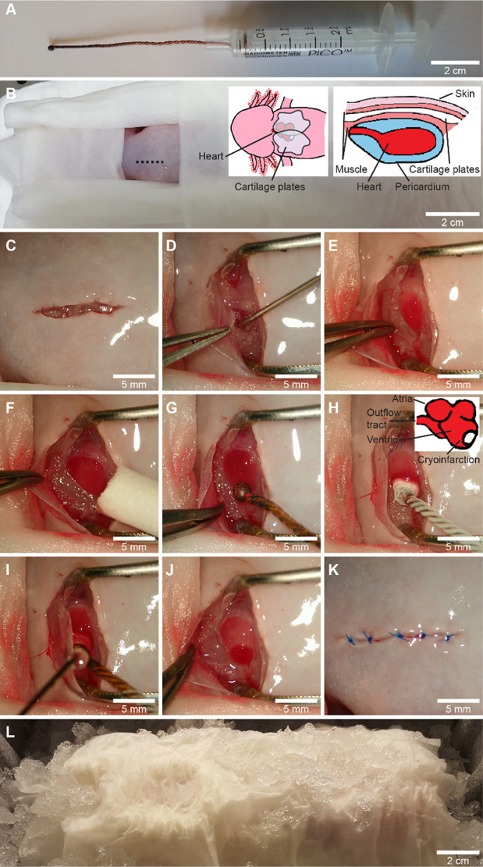 Cardiac surgery sequence with syringe catheter insertion, incision, cryoinfarction; diagram included.