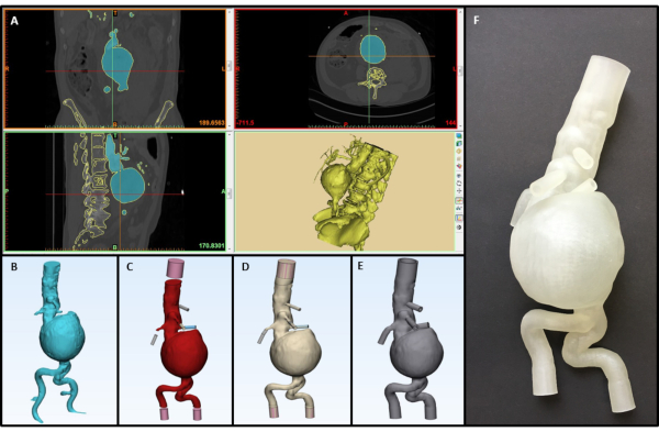 3D aortic aneurysm modeling, CT scan analysis, surgical planning, medical imaging comparison.