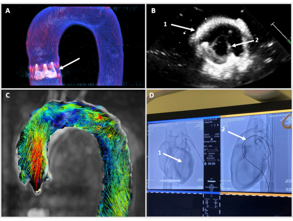 Aortic arch study; MRI, ultrasound, CT images; hemodynamic flow, cardiac assessment.