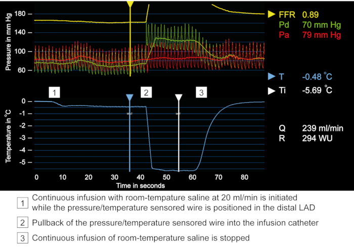 Cardiac catheterization data analysis; pressure-temperature graph; Pd/Pa ratios, saline infusion process.