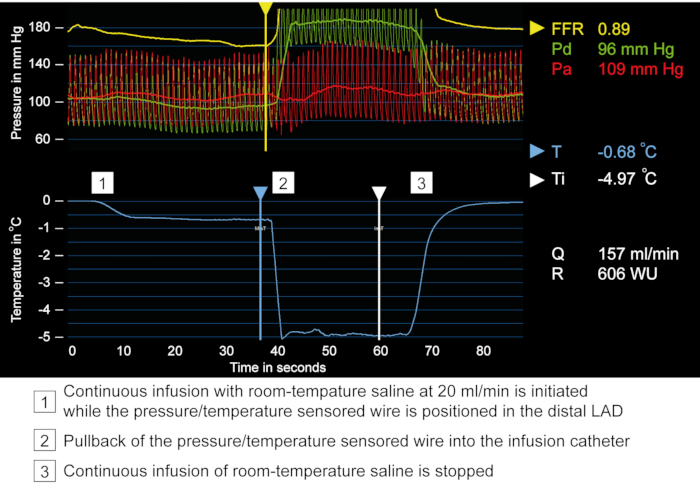 Cardiovascular pressure-temperature graph; saline infusion effects; distal LAD wire sensor data.