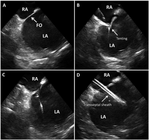Cardiac ultrasound series showing transseptal puncture using sheath in RA to LA, medical procedure.
