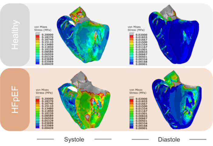figure-results-6 Heart stress analysis; von Mises stress diagram; systole-diastole comparison in healthy vs HFpEF.