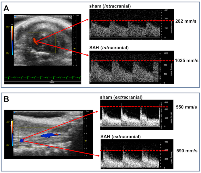 Intracranial and extracranial Doppler ultrasound results; blood flow velocities in SAH condition.