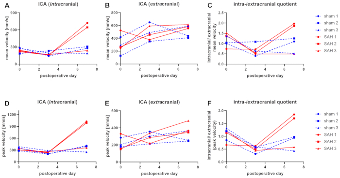 Intracranial flow analysis; graphs compare mean, peak velocities post-surgery; sham vs SAH groups.