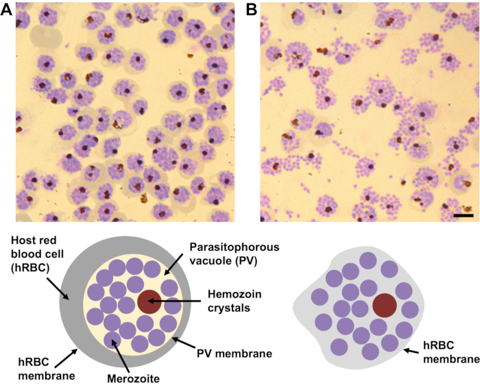figure-results-1 Malaria-infected red blood cells diagram; merozoite, hemozoin crystals, parasitophorous vacuole.
