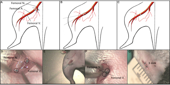Femoral nerve, artery, vein diagram and surgery; vascular dissection; anatomical location.