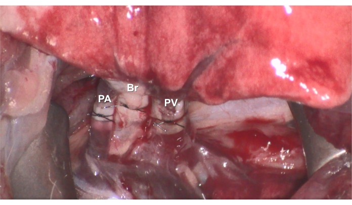 figure-results-7 Surgical anatomy; labeled pulmonary artery (PA), bronchus (Br), pulmonary vein (PV); educational use.