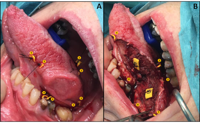 figure-protocol-1 Surgical procedure, oral cavity exploration, dental anatomy, tissue marking diagram, clinical analysis.