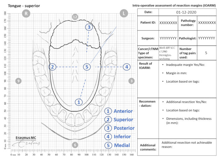 figure-protocol-2 Superior tongue resection margin assessment diagram; intra-operative analysis and data table results.