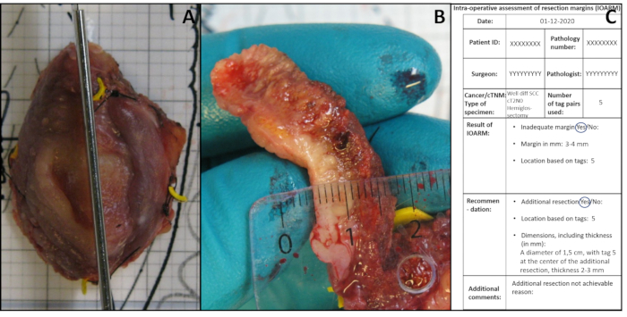 figure-protocol-3 Resection margin assessment, pathology specimen, surgical excision, ruler measurement, medical analysis.