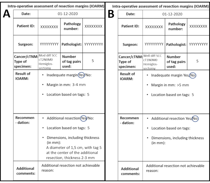 figure-results-1 Intra-operative resection margins assessment, table comparison of margins, recommendations, tags.