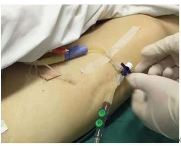Intravenous catheter insertion, healthcare procedure, venipuncture technique, medical equipment use.
