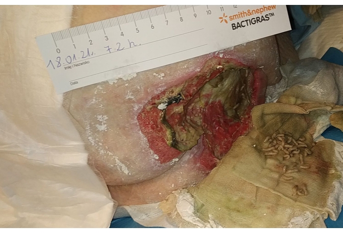 Wound care with ruler measurement; chronic ulcer evaluation; medical assessment method.