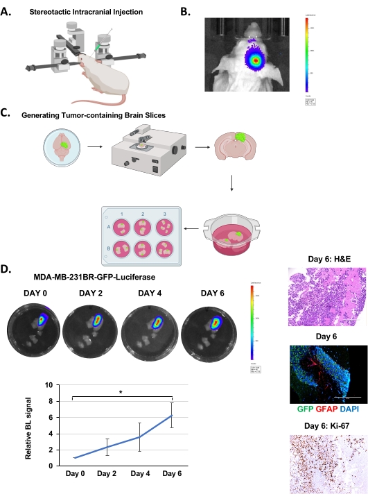 An Ex Vivo Brain Slice Model to Study and Target Breast Cancer Brain ...