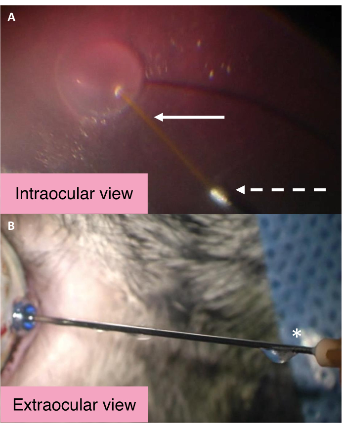 Intraocular and extraocular views, surgical procedure, eye surgery technique, ophthalmic operation.