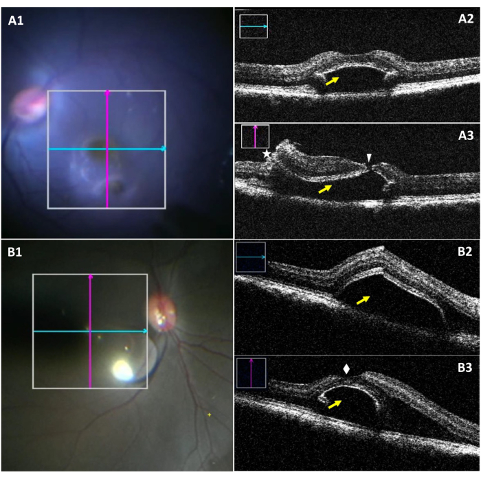 Retinal OCT diagram; cross-sectional imaging, macular analysis, potential fluid accumulation signs.