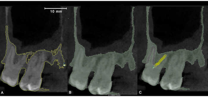 figure-protocol-1 Dental X-ray analysis, AI segmentation of tooth structure, diagram with dimensional scale indicator.