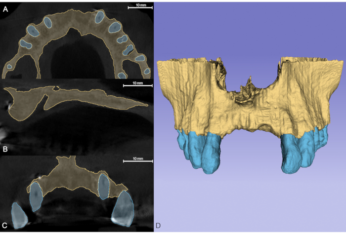 figure-protocol-3 Dental CT scan analysis with 3D reconstruction. Bone structure and tooth positioning diagram.