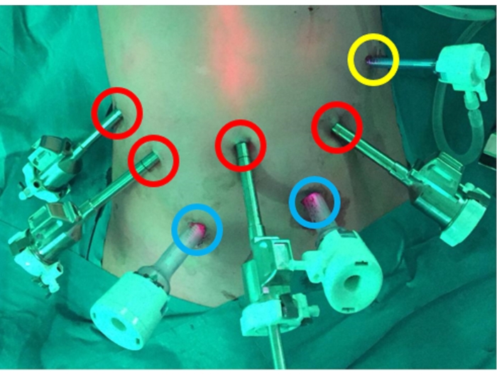 Laparoscopic surgery setup with multiple trocars for minimally invasive procedure.