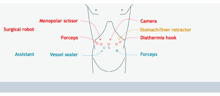 Surgical robot setup diagram; includes camera, forceps, vessel sealer, for abdominal procedure.