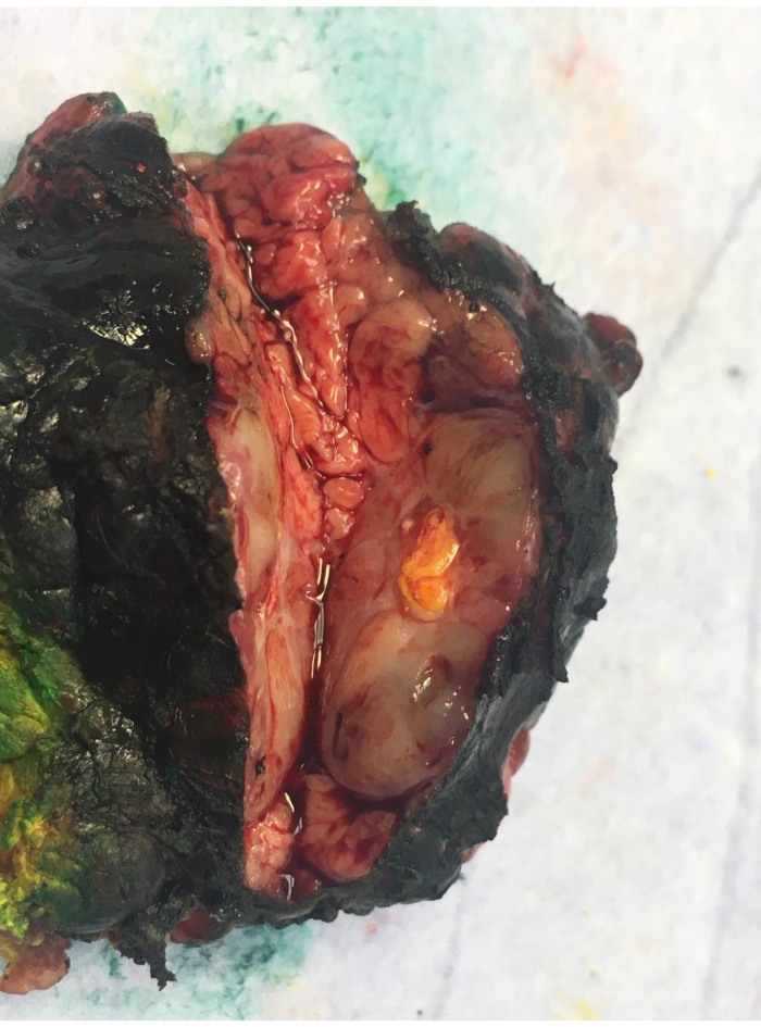 Surgical specimen showing cross-section of infected tissue with necrosis for pathological examination.