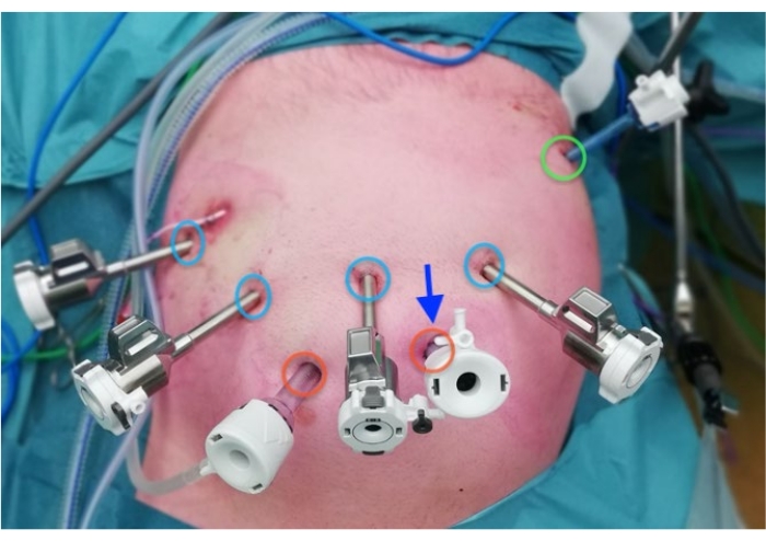 Laparoscopy setup diagram, surgical trocars inserted, minimally invasive procedure depiction.