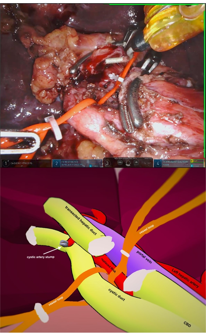 Surgical hepatectomy process and 3D liver anatomy diagram, illustrating vessel management.