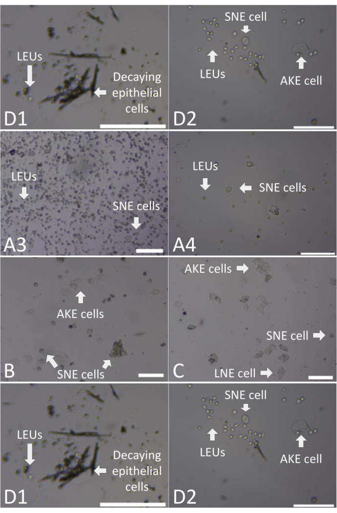 figure-results-6 Imágenes de microscopio que comparan células epiteliales: SNE, AKE, LEU, estructuras en descomposición; tipos de células etiquetadas.
