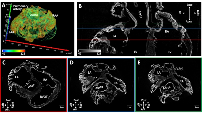 figure-results-5 Cardiac anatomy imaging; MRI cross-sections, 3D model; aorta, pulmonary artery, cardiac chambers.