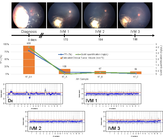 figure-results-2 Retinoblastoma treatment analysis, tumor volume reduction graph, intraocular measurements, clinical study.