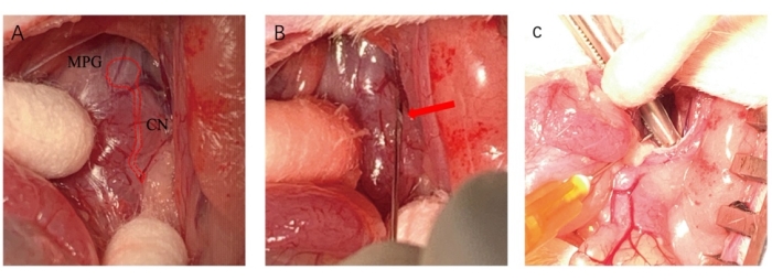 figure-results-2 Surgical procedure for nerve identification in pelvic anatomy, highlighting MPG and CN in dissection.
