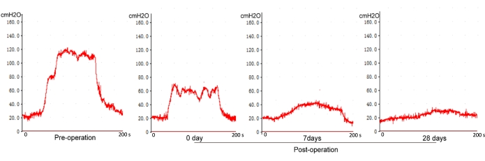 figure-results-8 Post-operative pressure trends; graph; cmH2O; four stages: pre-op to 28 days; respiratory analysis.